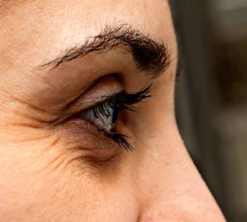 Cosmetic Laser Eyelid Surgery